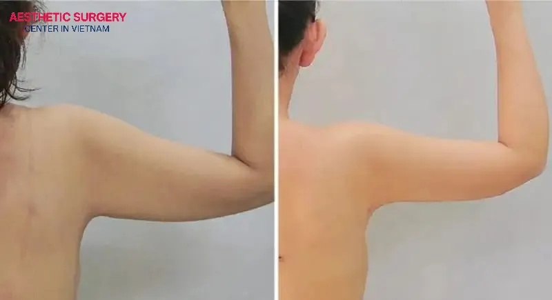 Before and after Arm Liposuction of the client at Aesthetics Surgery Center.