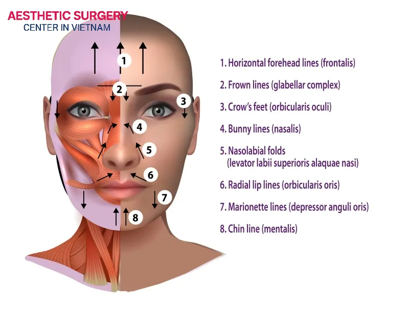 Botox can be injected into multiple areas of the face.