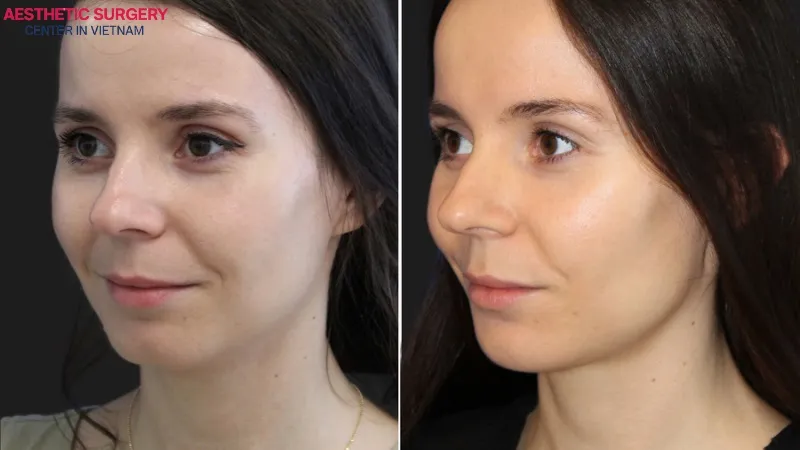 Cheek filler injections help the face appear fresher and more radiant.