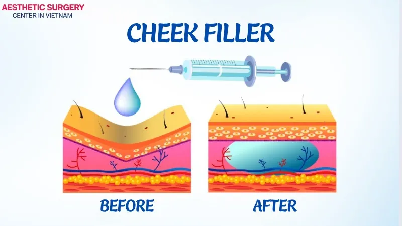 Cheek filler is a modern aesthetic procedure that fills hollow or sunken areas, helping the face look fresher and more balanced.