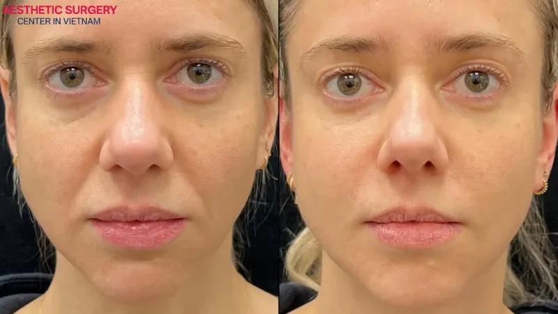 Before-and-after images clearly show a noticeable transformation in the overall facial appearance.