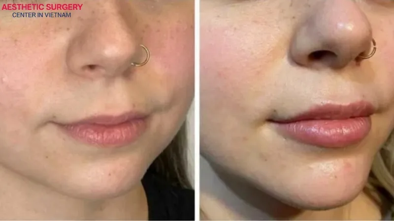 Before and after chin contouring filler.