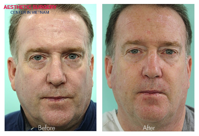 This treatment is not only for women, men can also benefit from CO2 laser resurfacing to improve their skin.