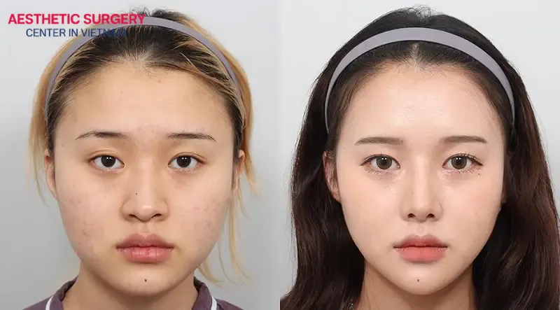 Cheekbone reduction surgery in Vietnam has helped thousands of women transform their appearance, making them look more youthful, delicate, and harmonious overall