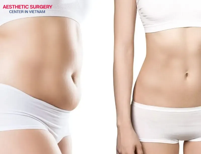 You should only undergo liposuction when your organs and bone structure are fully developed