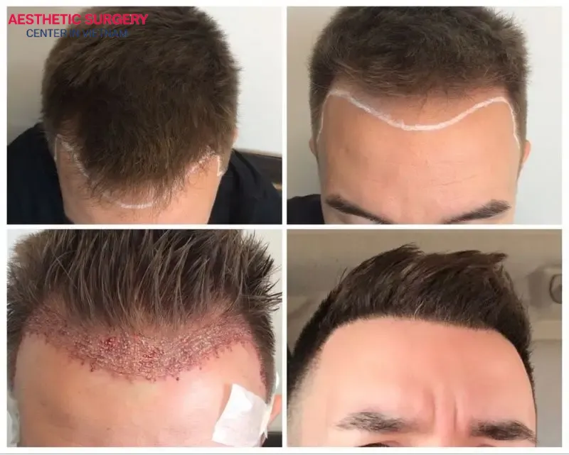 Not all types of hair have the same structure, thickness, and growth cycle as scalp hair