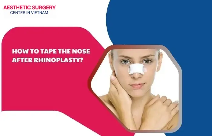 Taping nose after rhinoplasty