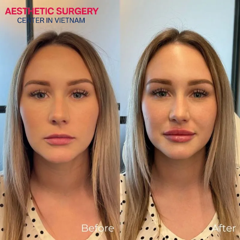 Filler injections at The Aesthetic Surgery Vietnam Centre helped the client achieve a more balanced and naturally harmonious facial proportion