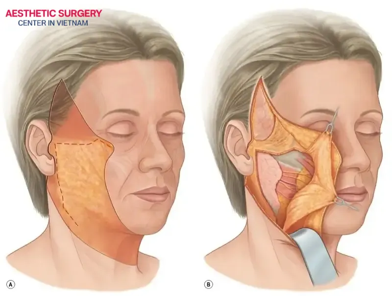Facelift surgery helps maintain results for a long period