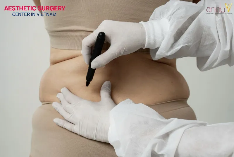 People in good health with stubborn localized fat deposits are generally the best candidates for liposuction