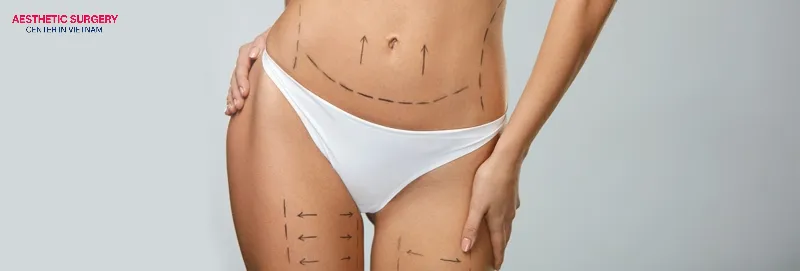 Liposuction in Vietnam ensures effectiveness and safety