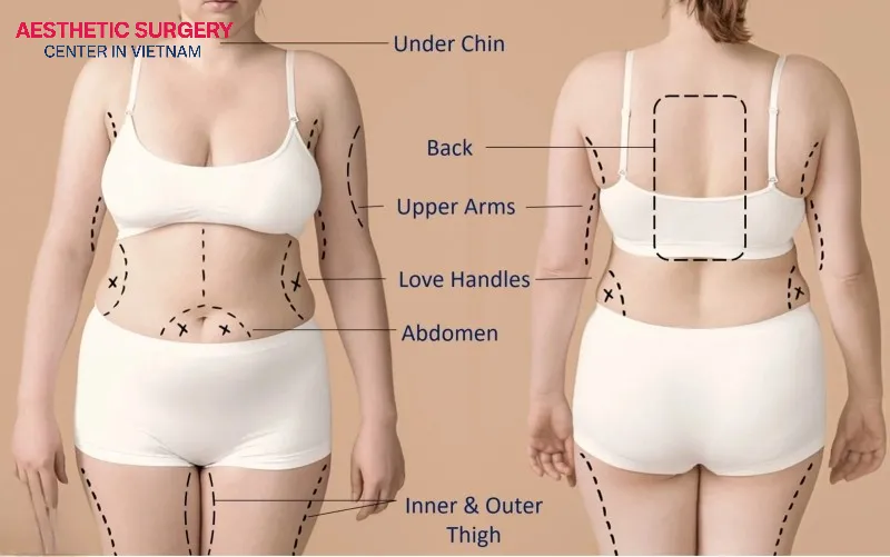 Many areas of the body can be effectively treated with liposuction