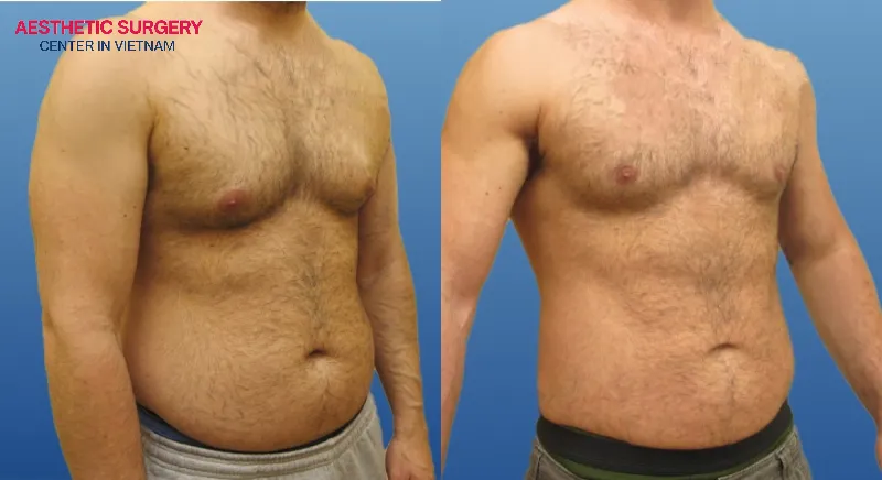 The body becomes firmer, and the abdominal muscles gradually become more defined after liposuction