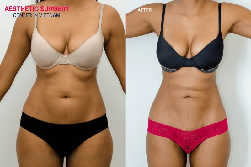 The body undergoes a dramatic transformation after liposuction, becoming slimmer and more attractive