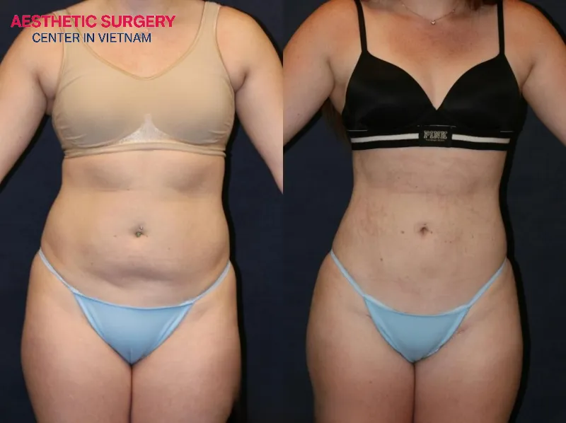 Excess fat is removed, simultaneously reducing the risk of many related health conditions
