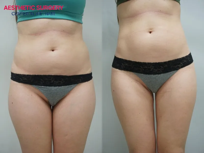 Before and after liposuction results of a client