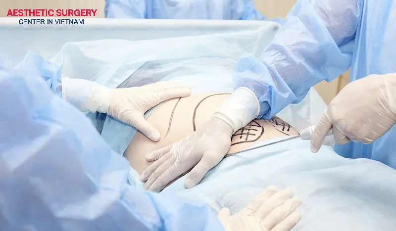 Liposuction service at Aesthetic Surgery Center is highly rated