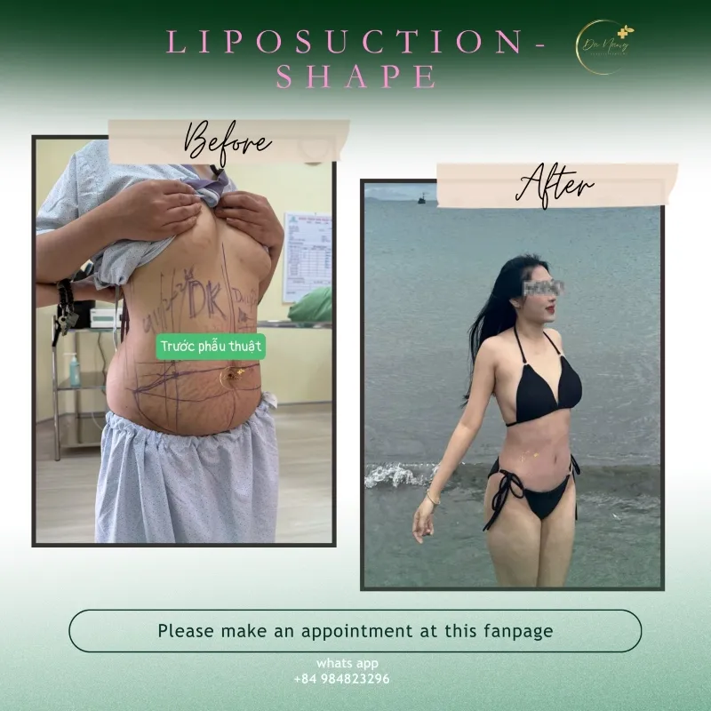 Impressive liposuction results at Da Nang Plastic Surgery