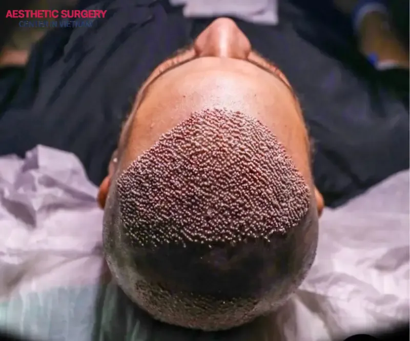 What is a hair transplant? This article will help you understand more and decide whether a hair transplant is worth it