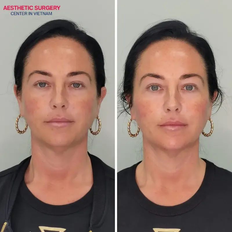 A second facelift helps women maintain a youthful appearance and smooth, firm skin over time