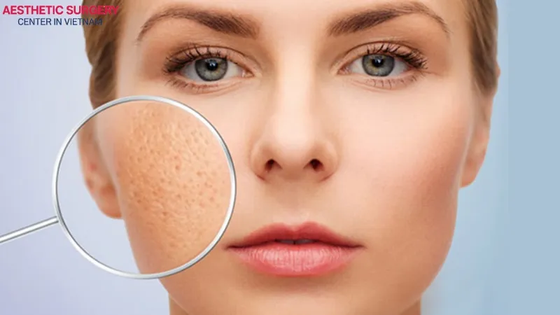 Enlarged pores are caused by various factors, leading to a loss of smoothness and radiance in the skin.