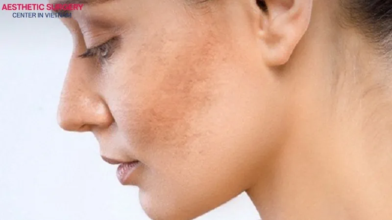 If performed at an unqualified clinic or by an inexperienced technician, the skin may suffer from burns or darkening.