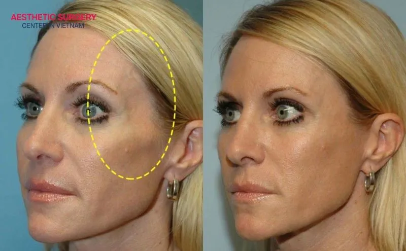 The temples appear noticeably fuller, creating a more balanced and harmonious facial appearance.