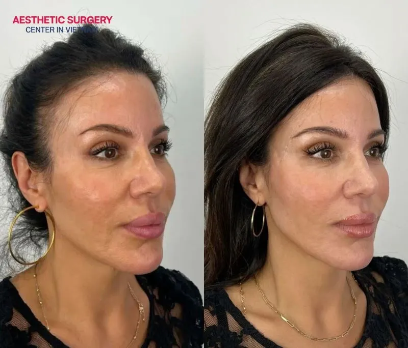 Enhancing clients’ beauty through temple filler treatment at Aesthetic Surgery Center.
