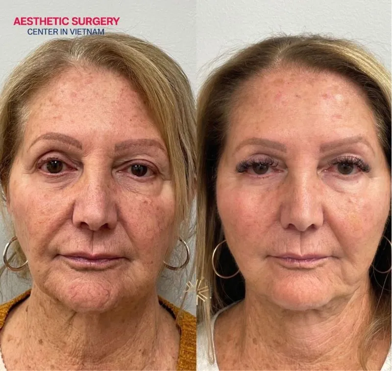 It delivers a fuller and more refreshed facial appearance immediately after the temple filler.