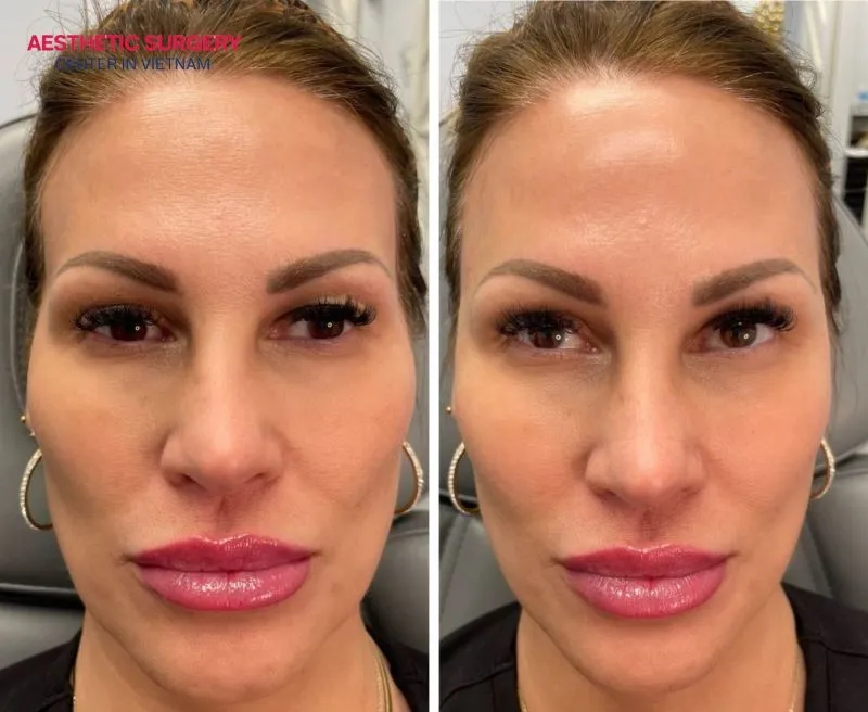 People with hollow temples are ideal candidates for temple filler, as it helps create a fuller, more youthful and refreshed appearance.