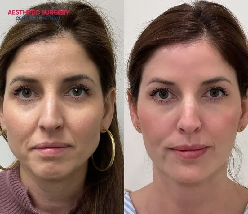 Before and after images of clients who enhanced their temple area with filler injections.
