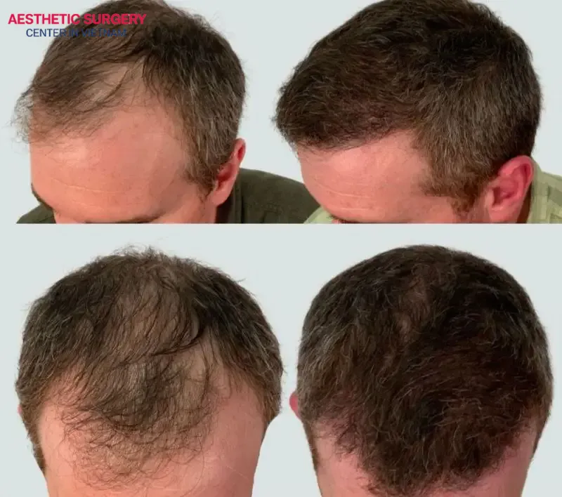 Customer’s hair condition before and after undergoing a hair transplant at Aesthetics Surgery Center