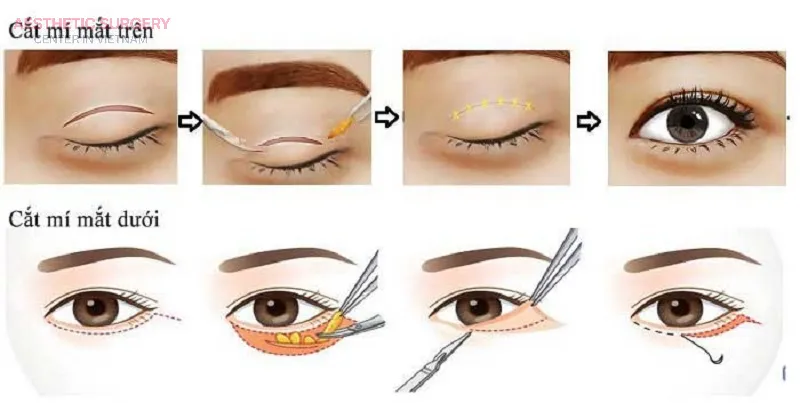 Upper and lower blepharoplasty