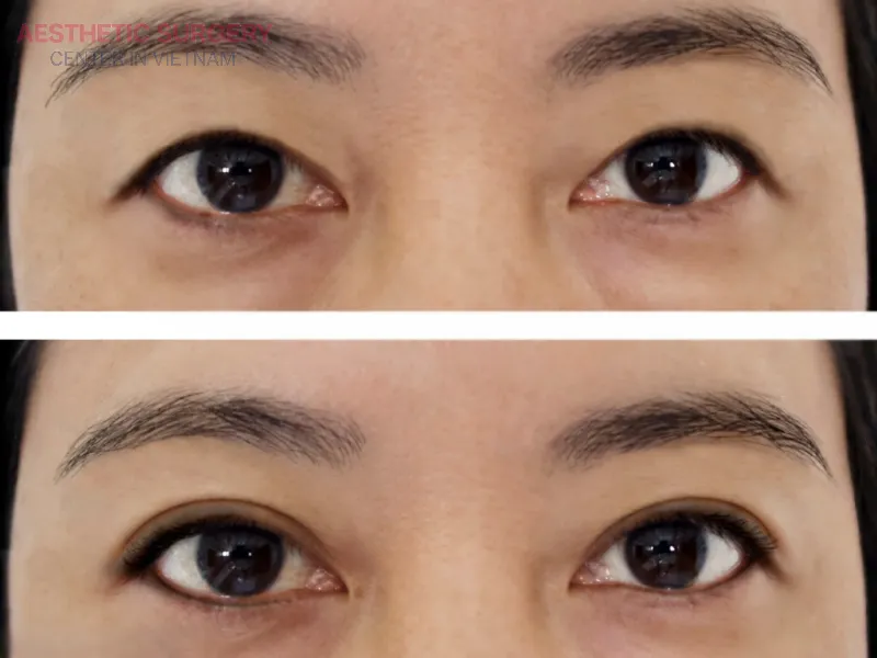 Upper blepharoplasty removes excess skin, fat, or muscle around the upper eyelid.