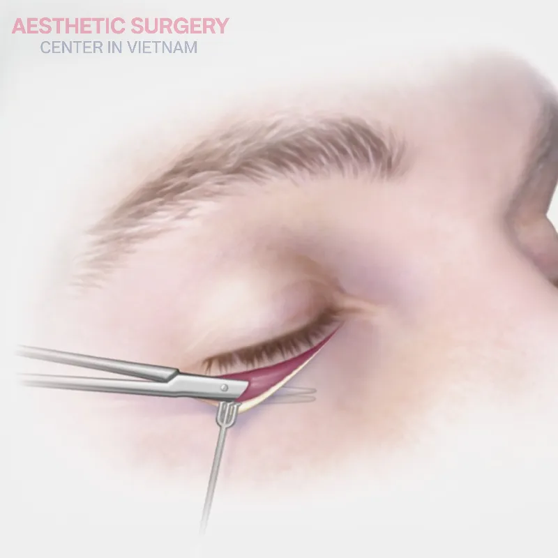 Lower blepharoplasty addresses under-eye bags, loose skin, and wrinkles beneath the eyes.
