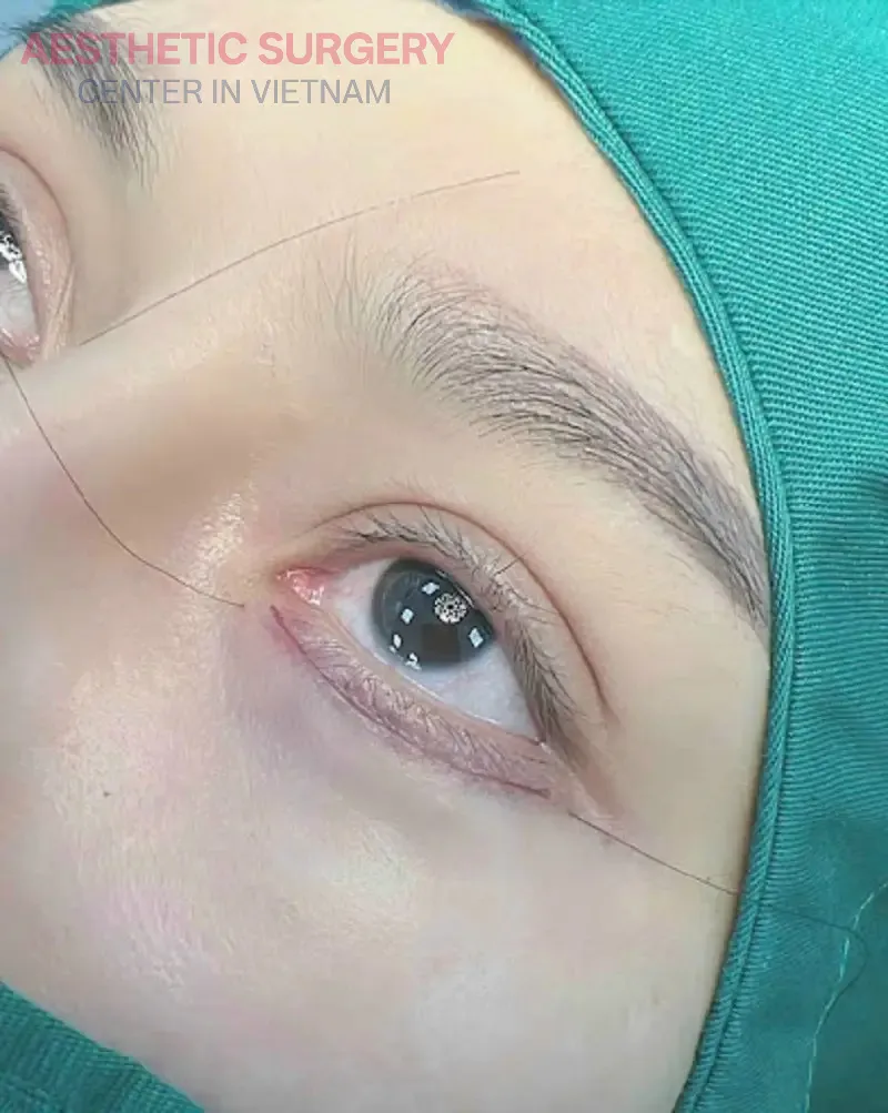 You need to ensure good health before undergoing upper and lower blepharoplasty.