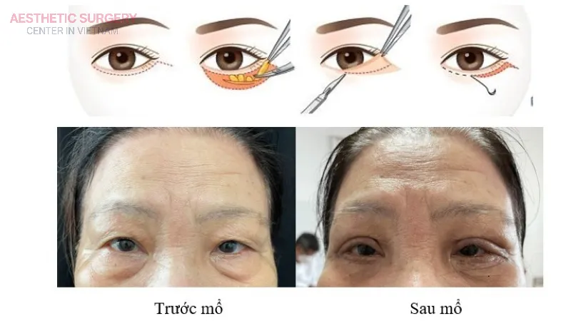 Noticeable changes before and after upper eyelid surgery