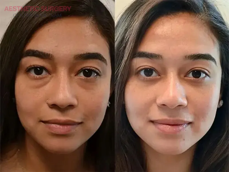 The overall appearance looks more youthful and radiant after eyelid adjustment.