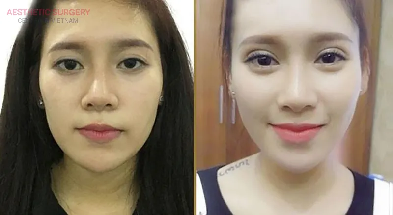The face looks more youthful and confident after eyelid surgery.
