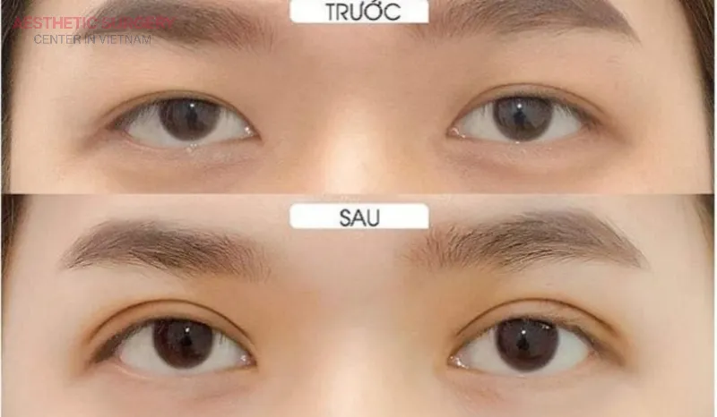 The face looks more youthful and confident after eyelid surgery.