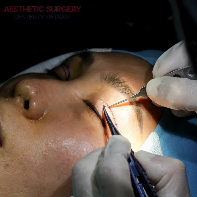 Aesthetic Surgery Center is a reputable provider of eyelid surgery services.