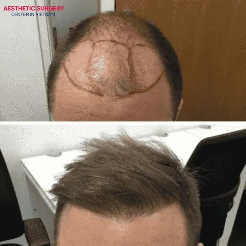 Body hair can be used to support scalp hair transplantation to increase density as desired