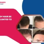 Can body hair be transplanted to scalp