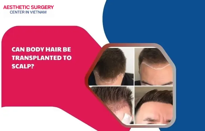 Can body hair be transplanted to scalp