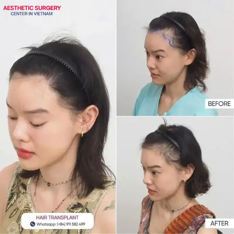 Before-and-after images of a female client undergoing a hair transplant at Aesthetics Surgery Center