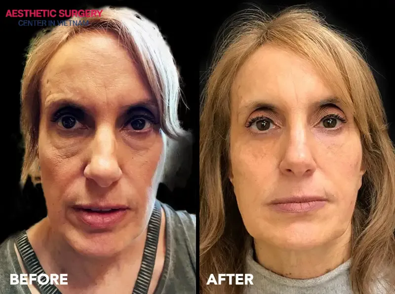The transformation of a woman before and after a liquid facelift