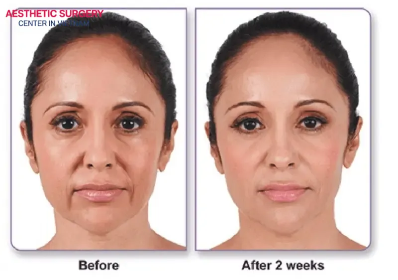 The average cost of a liquid facelift can range from VND 2,500,000 to VND 12,000,000