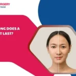 How long does a facelift last