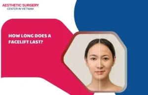 How long does a facelift last