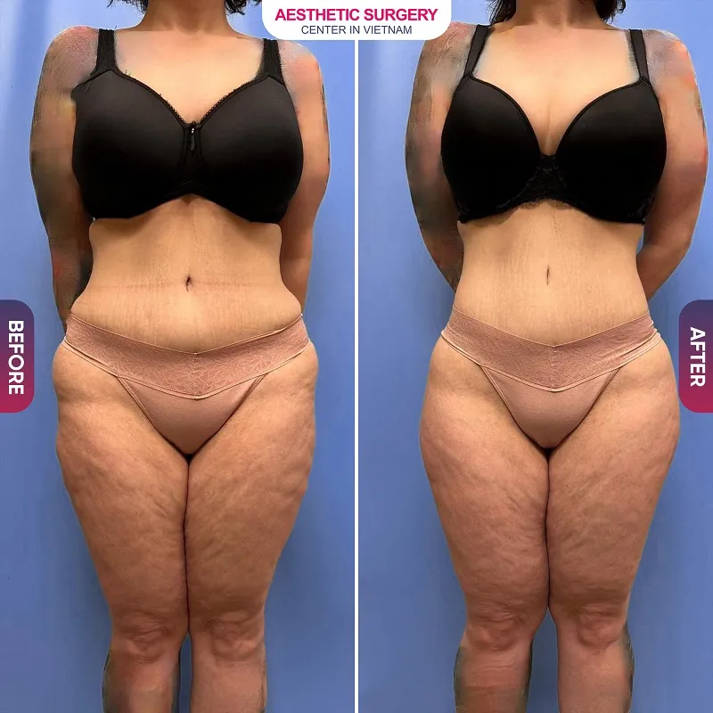 Before-and-after images of clients who underwent abdominal liposuction.